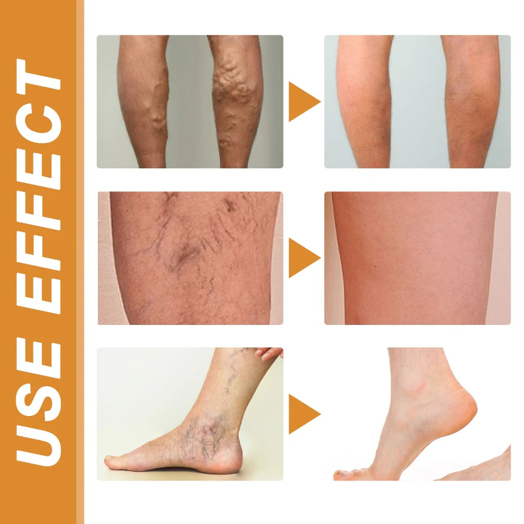 Turmeric Varicose Vein Relief Spray