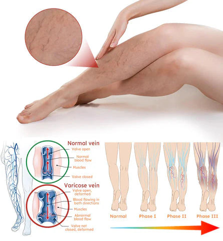 Turmeric Varicose Vein Relief Spray