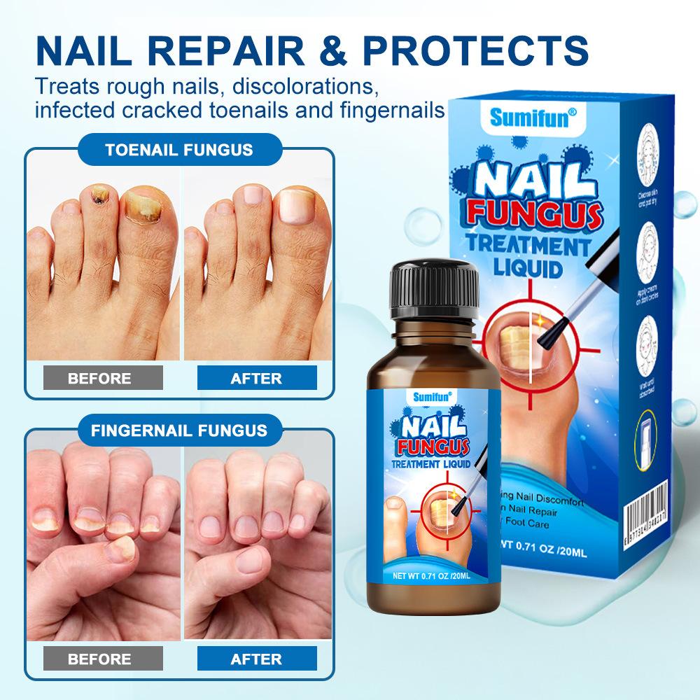 Herbal Anti-Fungal Nail Liquid