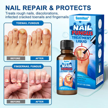 Herbal Anti-Fungal Nail Liquid