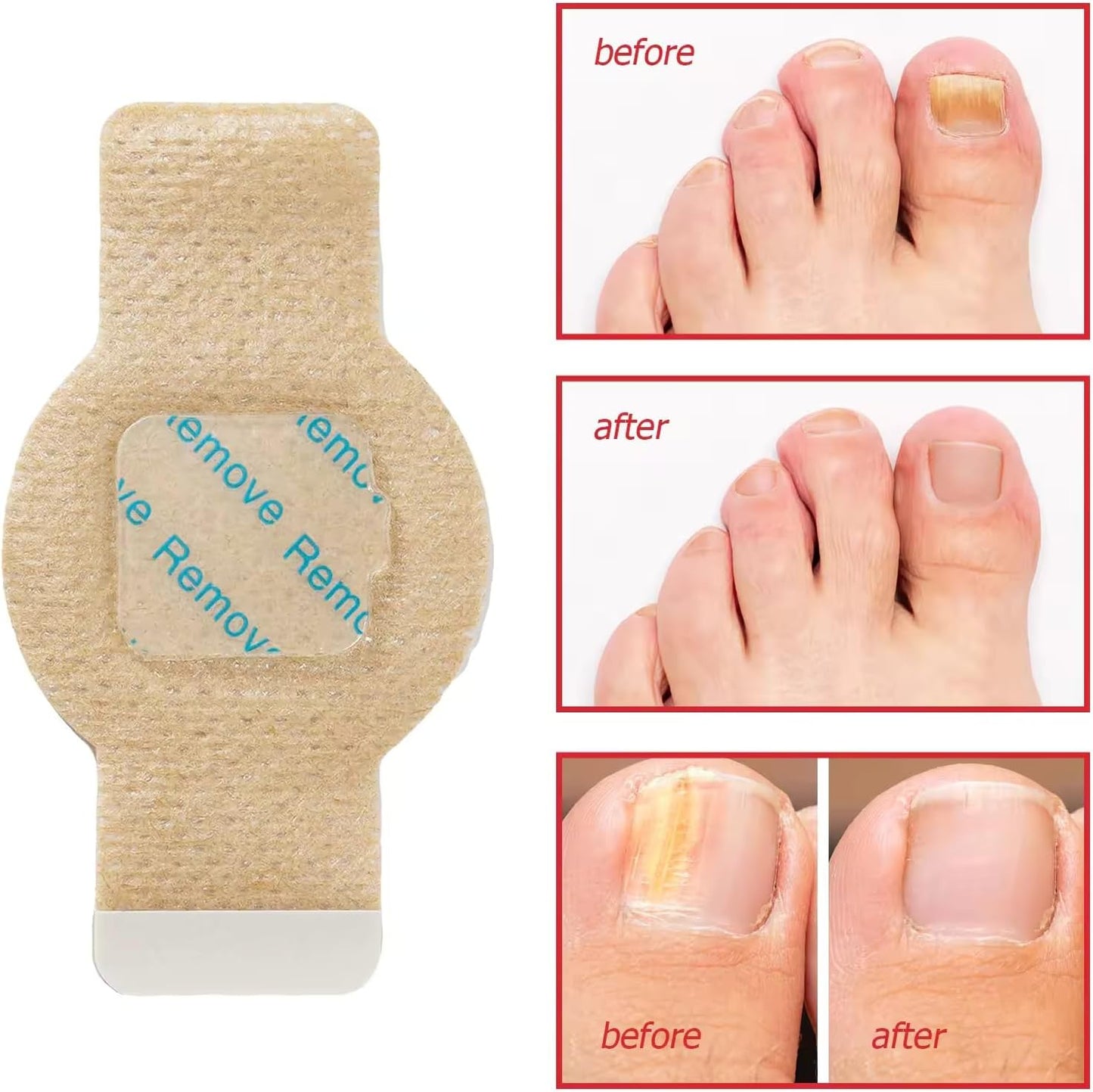 Nighttime Renewal Fungal Nail Patches