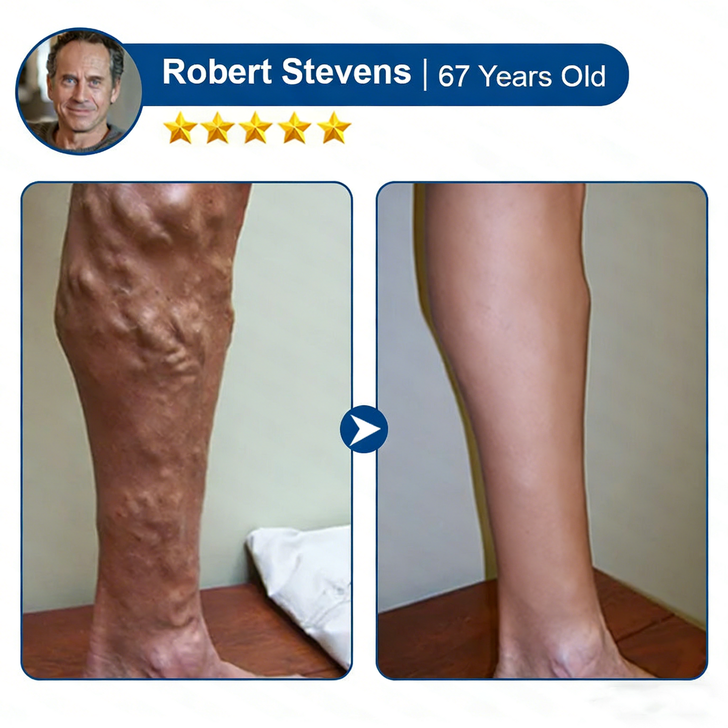 Varicose VeinTarget Microneedle Patch