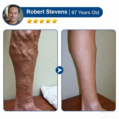 Varicose VeinTarget Microneedle Patch