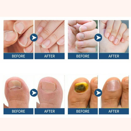 Tea Tree Nail Repair Patch