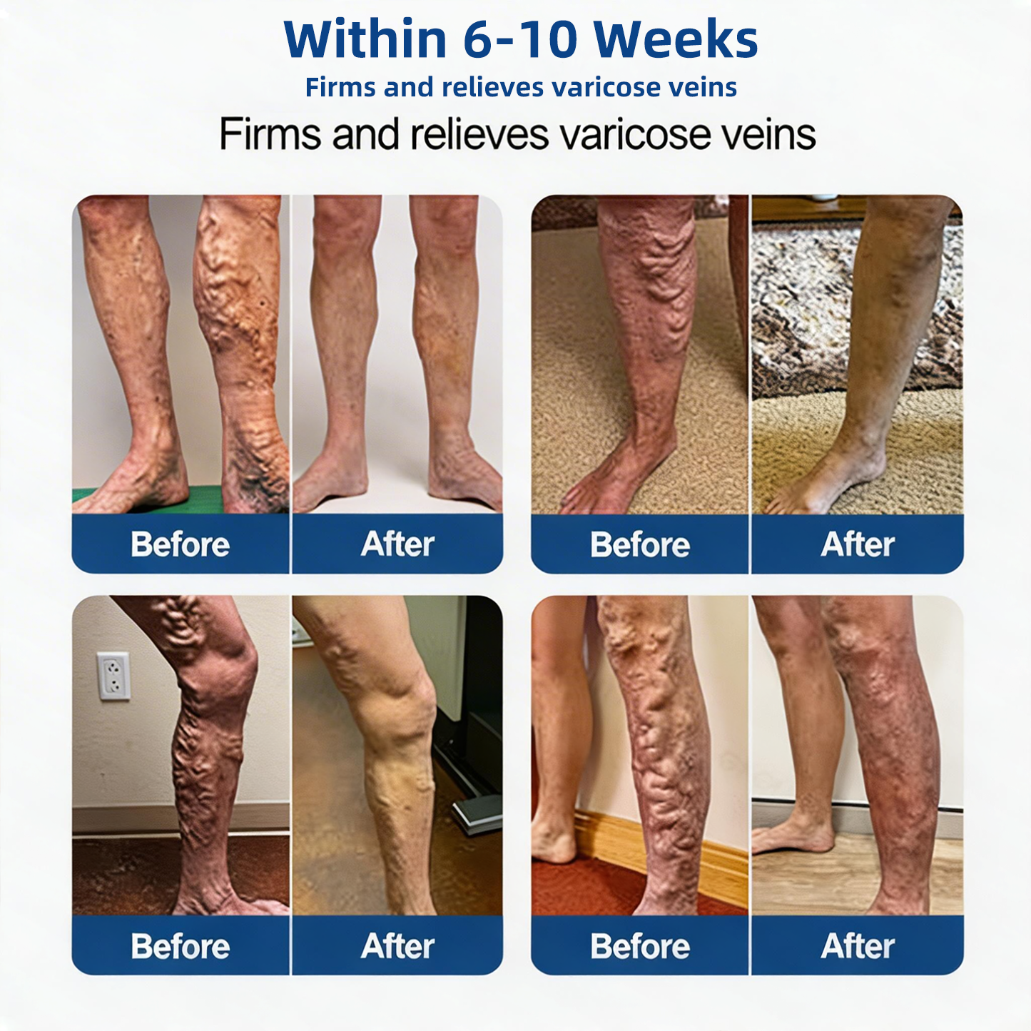 Varicose VeinTarget Microneedle Patch